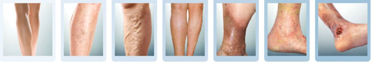 Stages of development of varicose veins in the legs