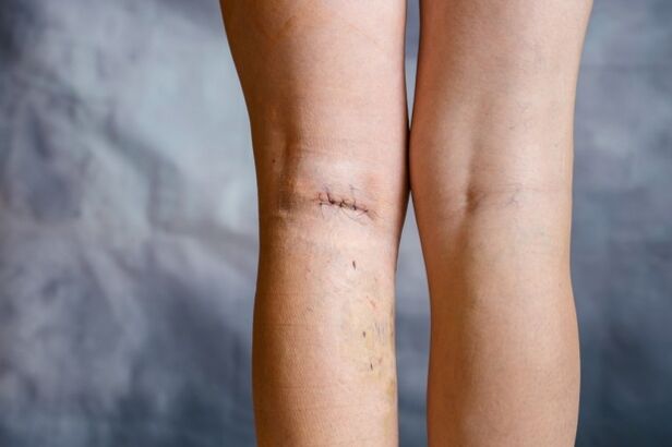 Leg joints after varicose vein surgery