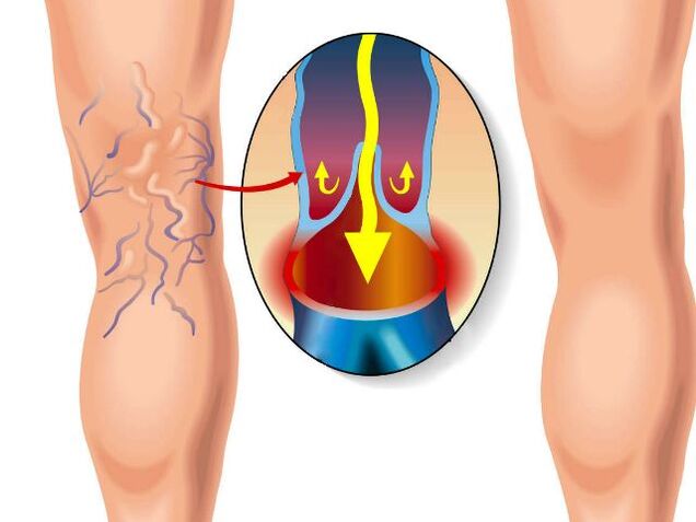 Healthy legs and leg varicose veins