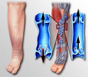 Blood flow from varicose veins in the legs