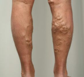 Nodules with varicose veins on the legs