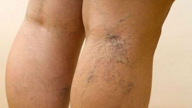 Varicose veins on the legs