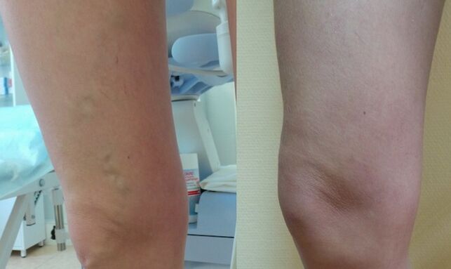 Legs before and after treatment of reticular varicose veins