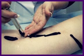 Procedure for treating varicose veins with leech (leech therapy)