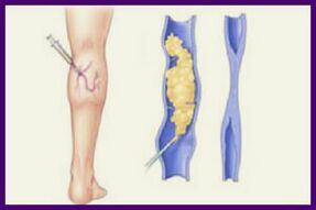 Sclerotherapy is a popular way to get rid of varicose veins on the legs