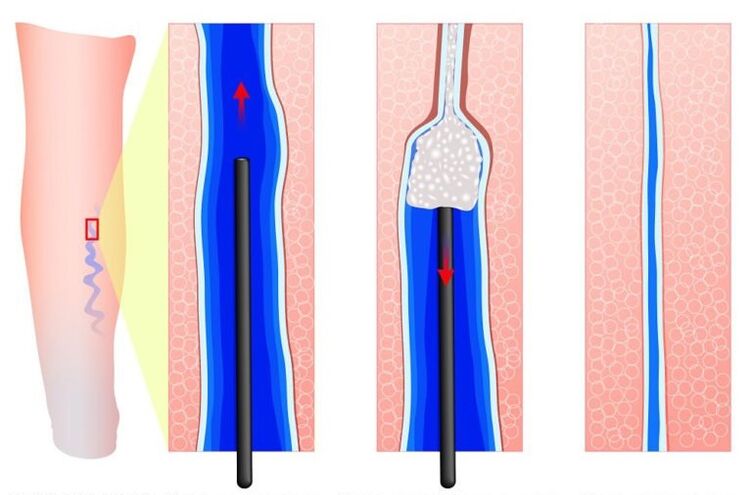 Sclerotherapy of varicose veins of the labia