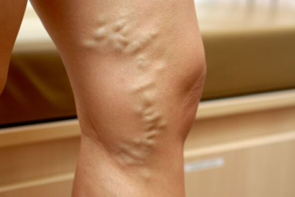 Varicose veins of the legs, small pelvic veins