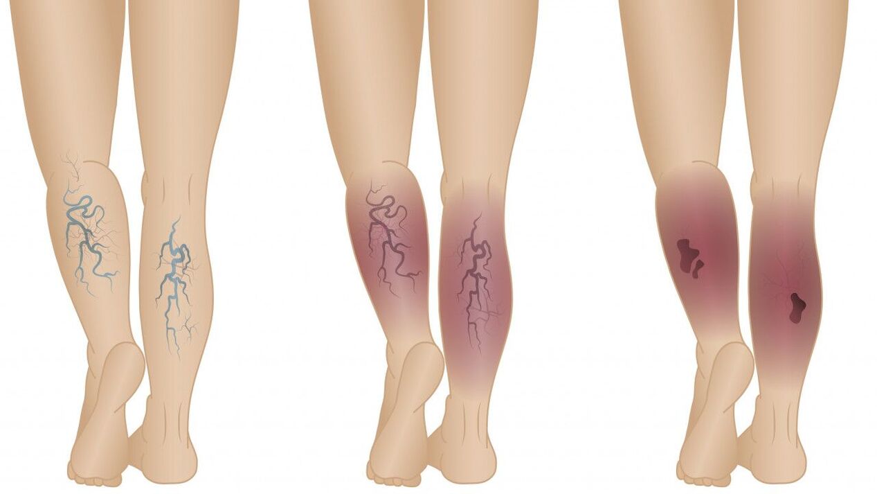 The stages of development of varicose veins