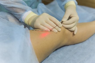 the laser treatment