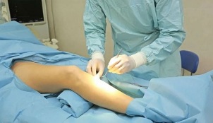 How to perform varicose vein surgery