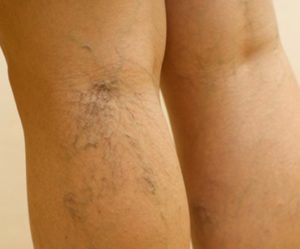 pain during the treatment of varicose veins