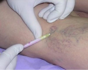 pain in varicose veins fluids treatment