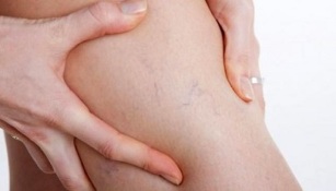 How does varicose veins manifest
