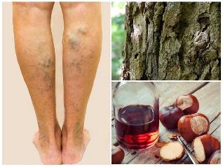 treatment of varicose veins of the veins of the legs folk remedies