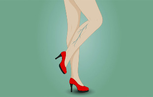 Varicose veins on woman legs
