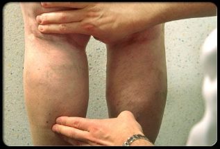Doctor checking legs for varicose veins