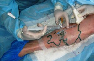 how to get rid of varicose veins operation