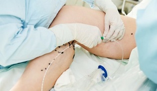 Methods of treating varicose veins in women's legs