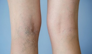 Signs of varicose veins on women's legs