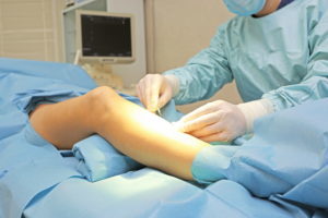The operation for varicose veins
