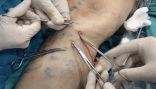 How to remove varicose veins during phlebotomy
