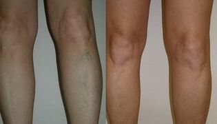 The main manifestations of male varicose veins