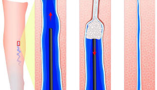 The introduction of the sclerotherapy with sclerotherapy