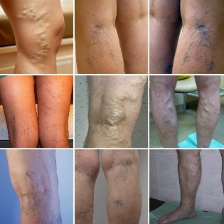Pictures of varicose veins of the lower limb veins